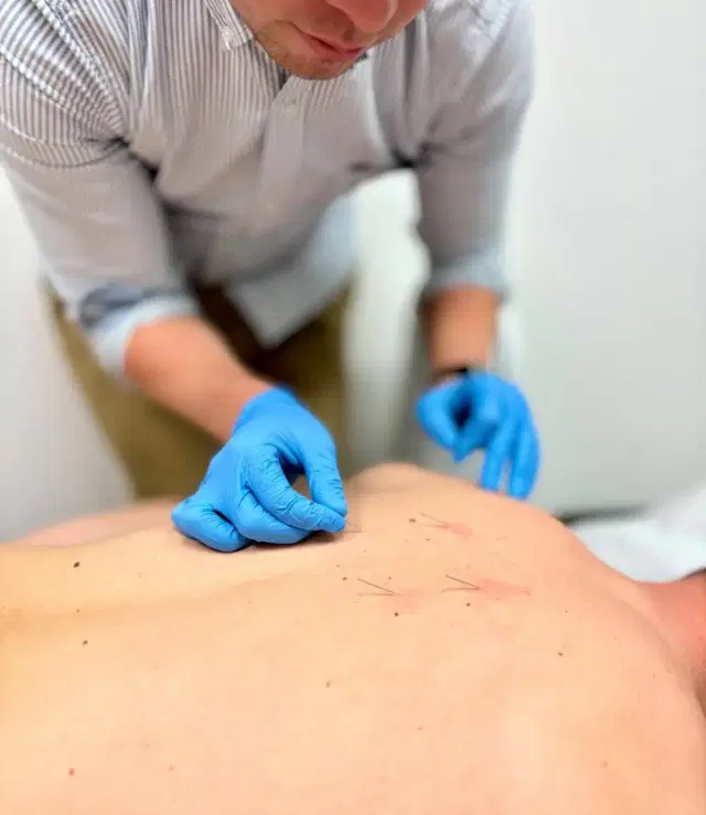 Dry Needling
